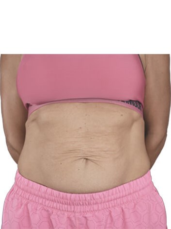 Before and After RF Skin Resurfacing & Plasma Skin Resurfacing & RF